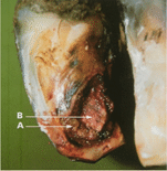 Рисунок 9. В запущенных случаях кориум (А) может полностью разъесться, обнажая копытцевую кость (В).